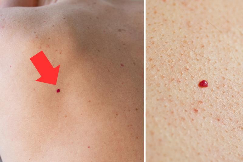 נקודות אדומות קטנות על העור? זה מה שהן אומרות