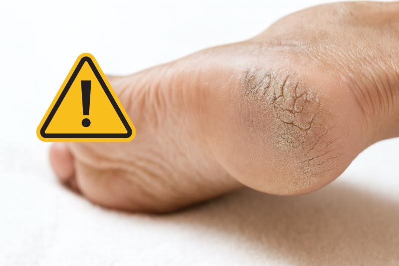 עקבים סדוקים? זה לא תמיד יובש! הסימן שהגוף שולח לכם