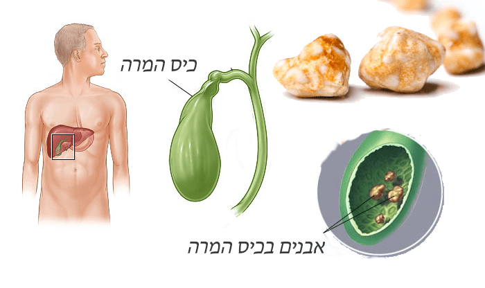 איך לטפל באבנים בכיס המרה