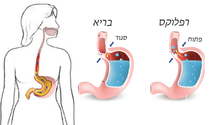 מה זה רפלוקס קיבתי ושטי? כאבים, תסמינים, גורמים וטיפולים