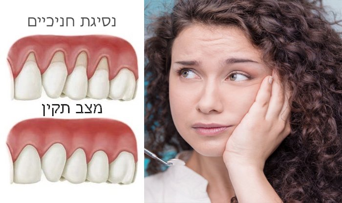 נסיגת חניכיים: גורמים, דרכי טיפול ומניעה