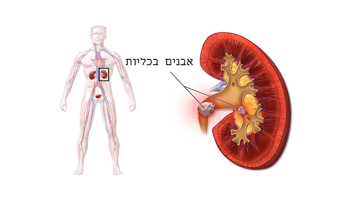 אבנים בכליות: סימנים, גורמים ודרכי טיפול