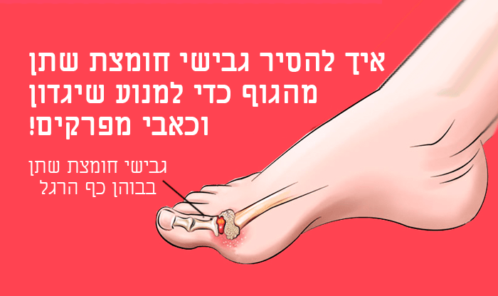 איך לטפל ברמת חומצת שתן גבוהה