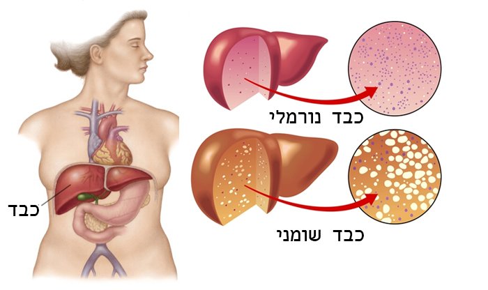 כבד שומני: גורמים, תסמינים ודרכי טיפול