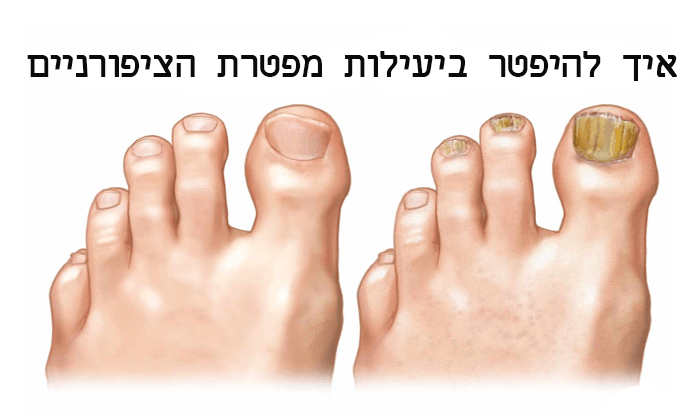 פטרת ציפורניים: גורמים, סימנים ודרכי טיפול