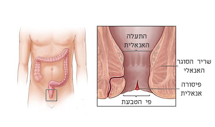 פיסורה אנאלית: תסמינים, גורמים ודרכי טיפול