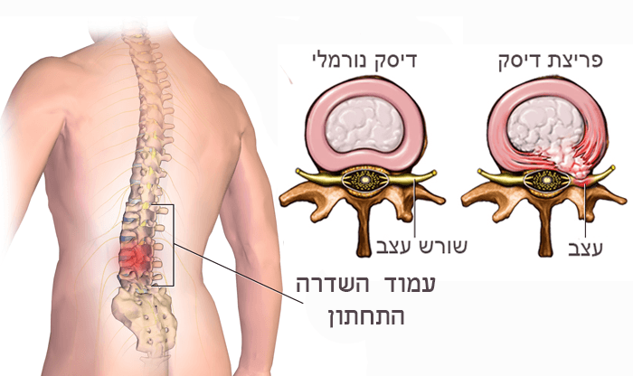 פריצת דיסק: תסמינים, גורמים ודרכי טיפול