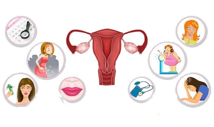 תסמונת השחלות הפוליציסטיות (PCOS)