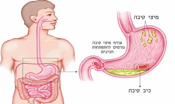 אולקוס (כיב קיבה): גורמים, תסמינים ודרכי טיפול