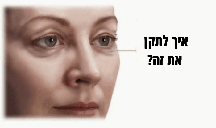 כיצד להיפטר מנפיחות ועיגולים שחורים בעיניים