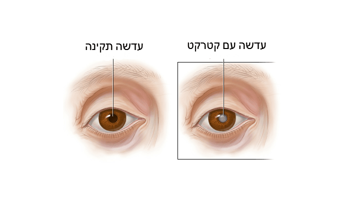 קטרקט: סוגים, תסמינים, גורמים ודרכי טיפול