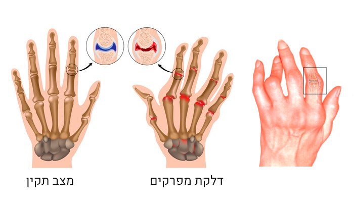 דלקת מפרקים שיגרונית: תסמינים, גורמים וטיפול