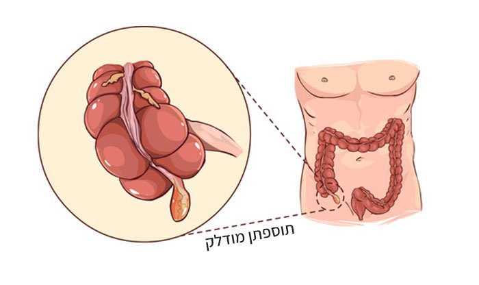 דלקת התוספתן (אפנדיציט): גורמים, תסמינים ודרכי טיפול