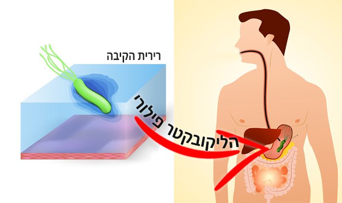 14 דרכים טבעיות לטיפול בהליקובקטר פילורי