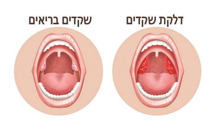 דלקת שקדים: גורמים, תסמינים ודרכי טיפול