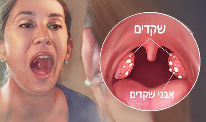 אבני שקדים: תסמינים, גורמים ודרכי טיפול