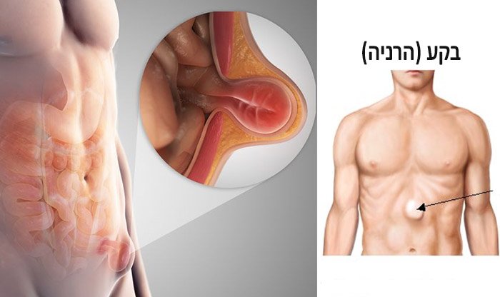 בקע (הרניה): גורמים, תסמינים, טיפולים ומניעה