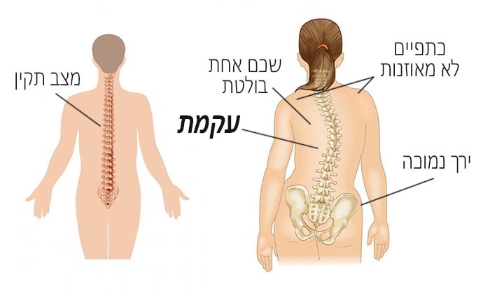 עקמת: סוגים, גורמים, תסמינים, אבחון, מניעה וטיפול