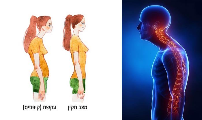 עקשת (קיפוזיס): תסמינים, גורמים, אבחון ודרכי טיפול