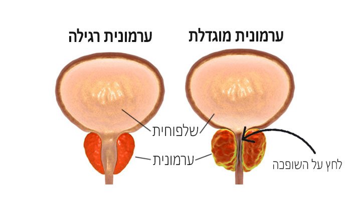 ערמונית מוגדלת: גורמים, תסמינים, אבחון וטיפול