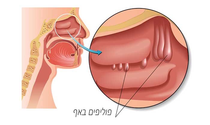 פוליפים באף – תסמינים, גורמים ודרכי טיפול