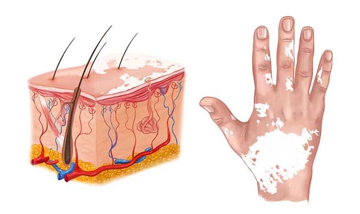 ויטיליגו: סוגים, גורמים, סימפטומים ודרכי טיפול