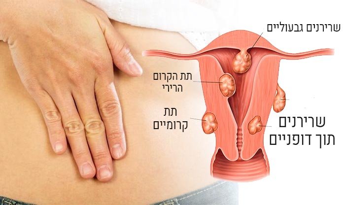 שרירני רחם: סוגים, גורמים, סימפטומים, טיפולים