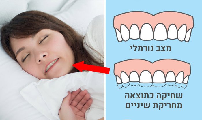 חריקת שיניים – סימנים, גורמים וטיפול