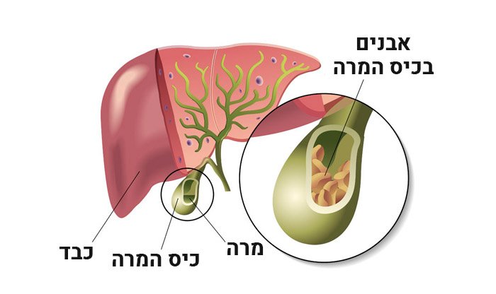 אבנים בכיס המרה – גורמים, תסמינים ודרכי טיפול