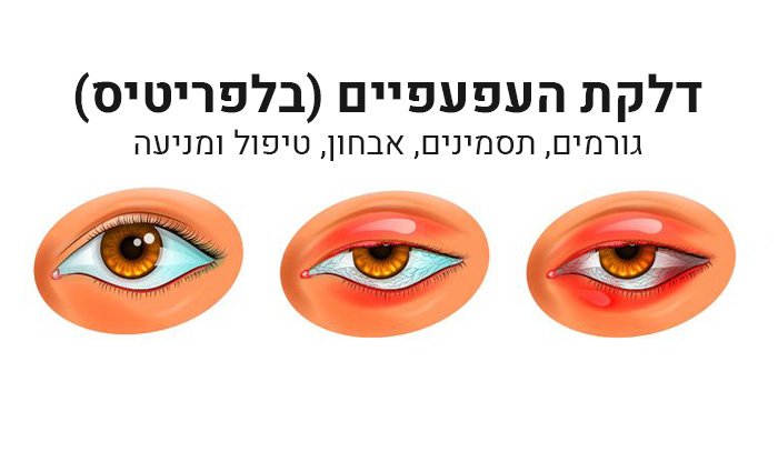 דלקת עפעפיים (בלפריטיס) – גורמים, תסמינים, אבחון, טיפול ומניעה