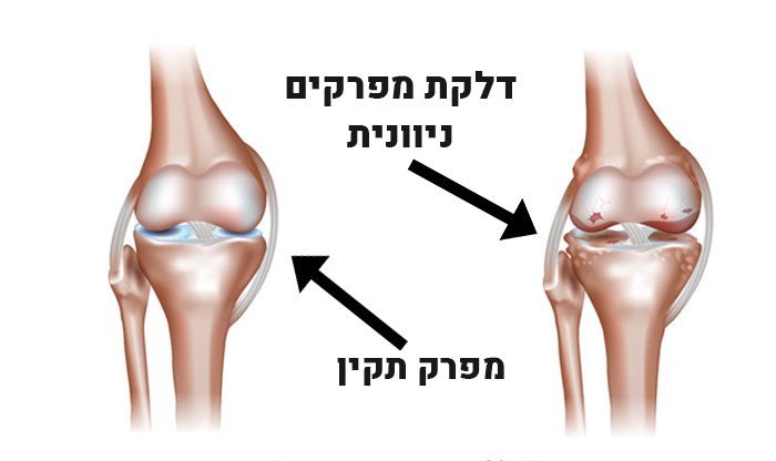 דלקת מפרקים ניוונית – גורמים, תסמינים, טיפולים ומניעה