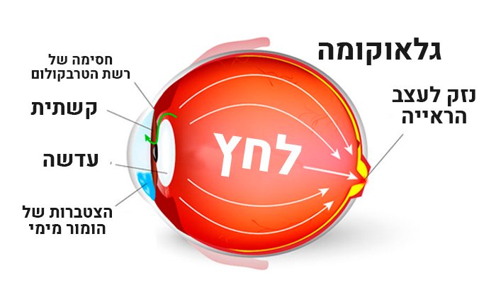 גלאוקומה – גורמים, תסמינים ודרכי טיפול