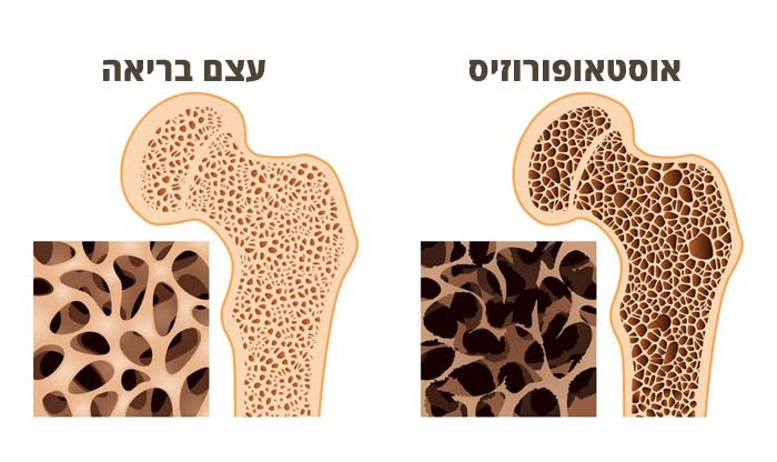 אוסטאופורוזיס: גורמים, סימפטומים, טיפול ומניעה