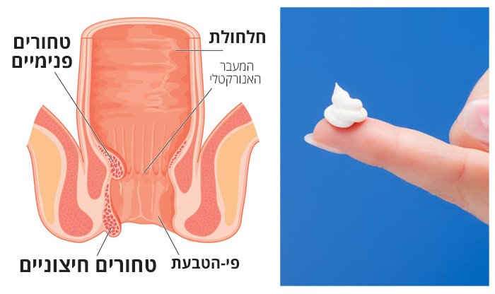 סובלים מאי נוחות/כאב/דימום בפי הטבעת? כדאי שתכירו את פיילפיקס להקלה והרגעה אפקטיבית