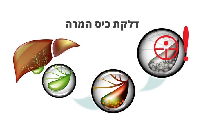 דלקת כיס המרה – גורמים, תסמינים ודרכי טיפול