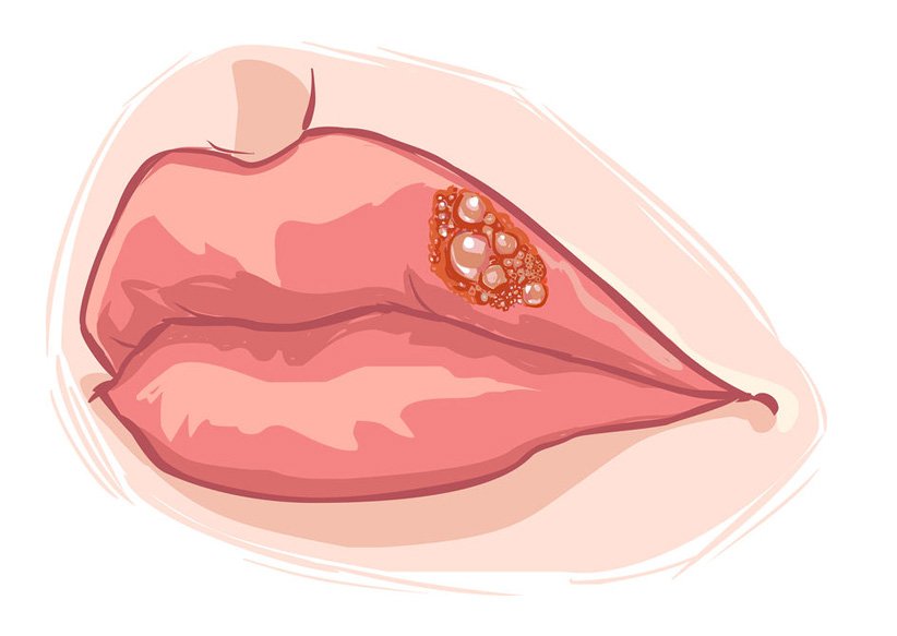 הרפס סימפלקס – גורמים, תסמינים, טיפול ומניעה