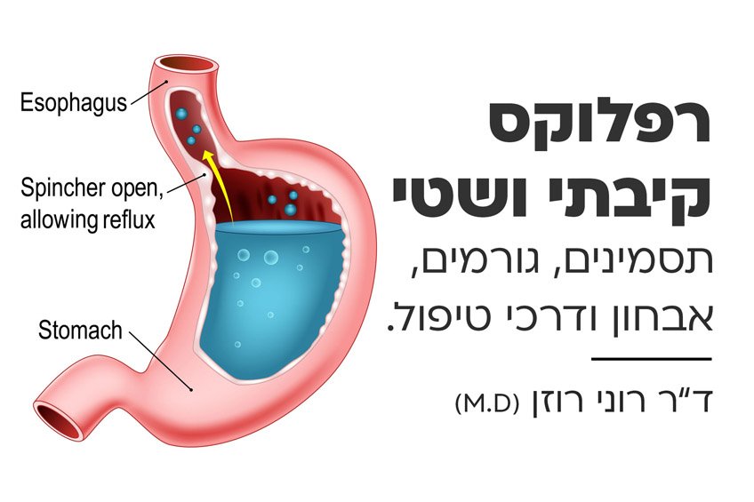 רפלוקס קיבתי ושטי – גורמים, תסמינים, דרכי טיפול ומניעה