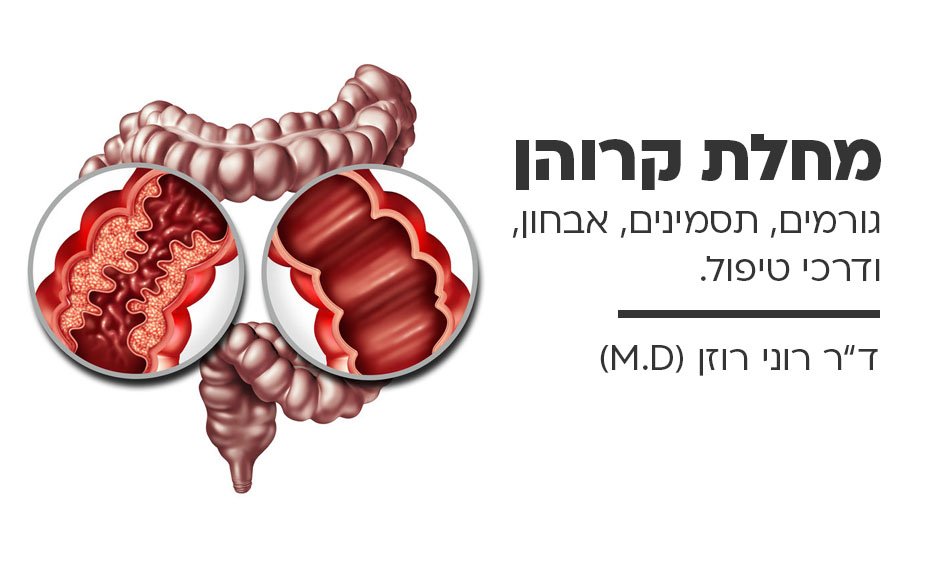 מחלת קרוהן – גורמים, תסמינים, אבחון ודרכי טיפול