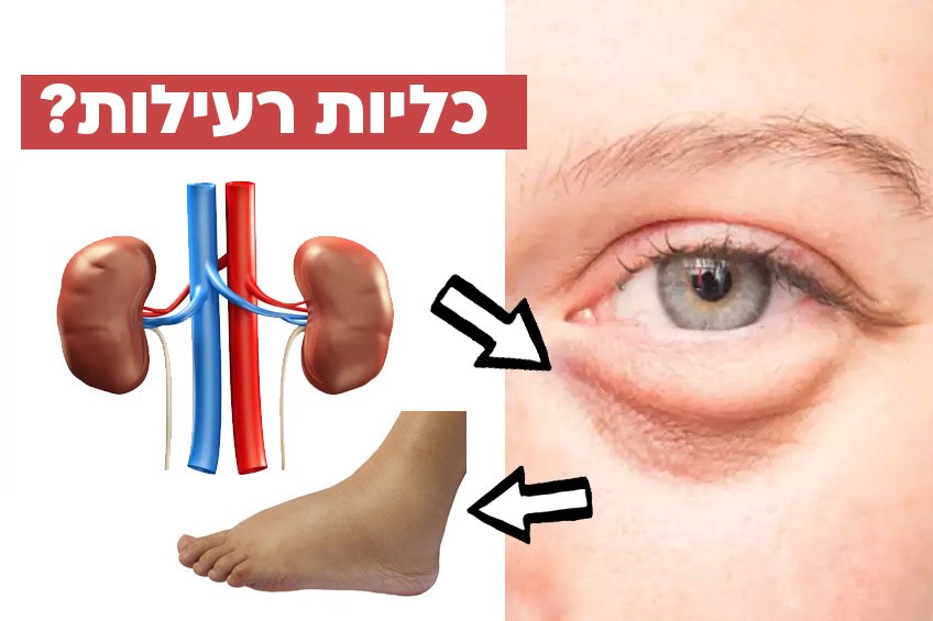 מחלת כליות כרונית – גורמים, תסמינים, דרכי טיפול