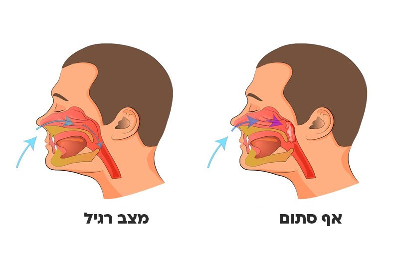 איך לטפל באף סתום?