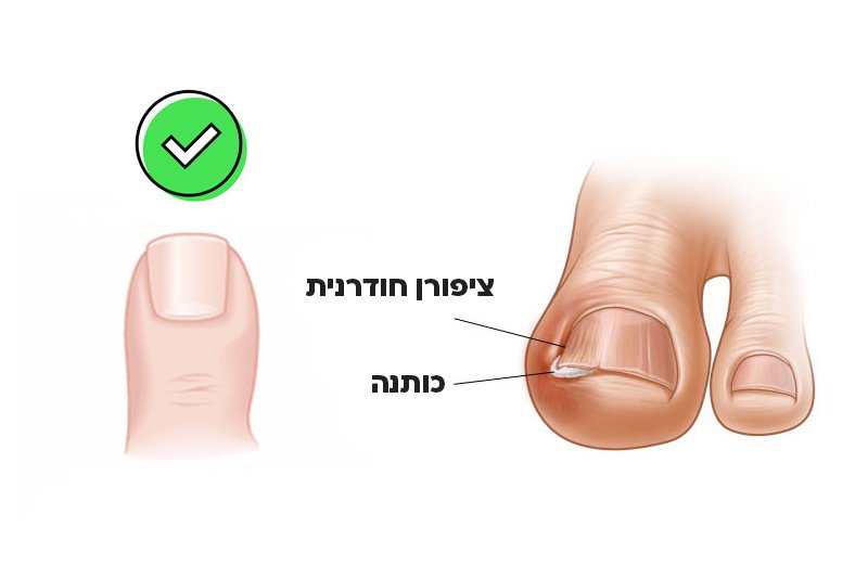 איך מטפלים בציפורן חודרנית