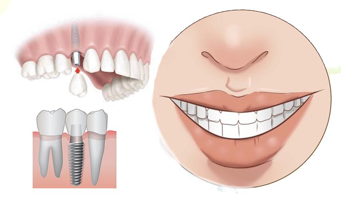 שתלים דנטליים: יתרונות, סיכונים וכל מה שצריך לדעת