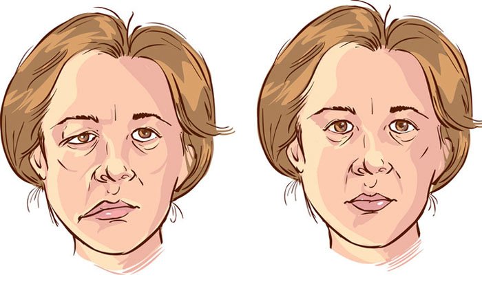 שיתוק על שם בל – גורמים, תסמינים ודרכי טיפול