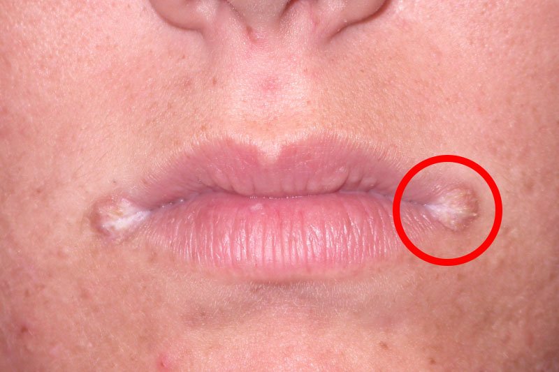 דלקת זווית הפה – גורמים ודרכי טיפול