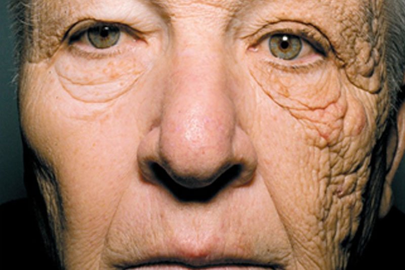 הצטברות נזקי שמש בצד שמאל של הפנים של נהג משאית