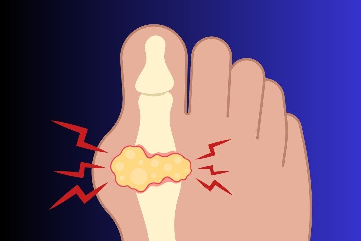 מהם הגורמים לגאוט?