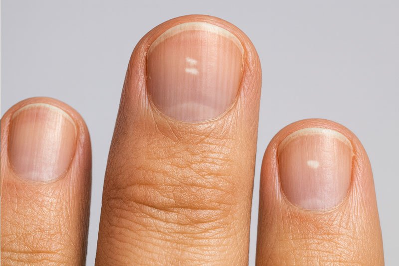 למה יש נקודות לבנות בציפורניים ומה הן אומרות על הבריאות שלנו?